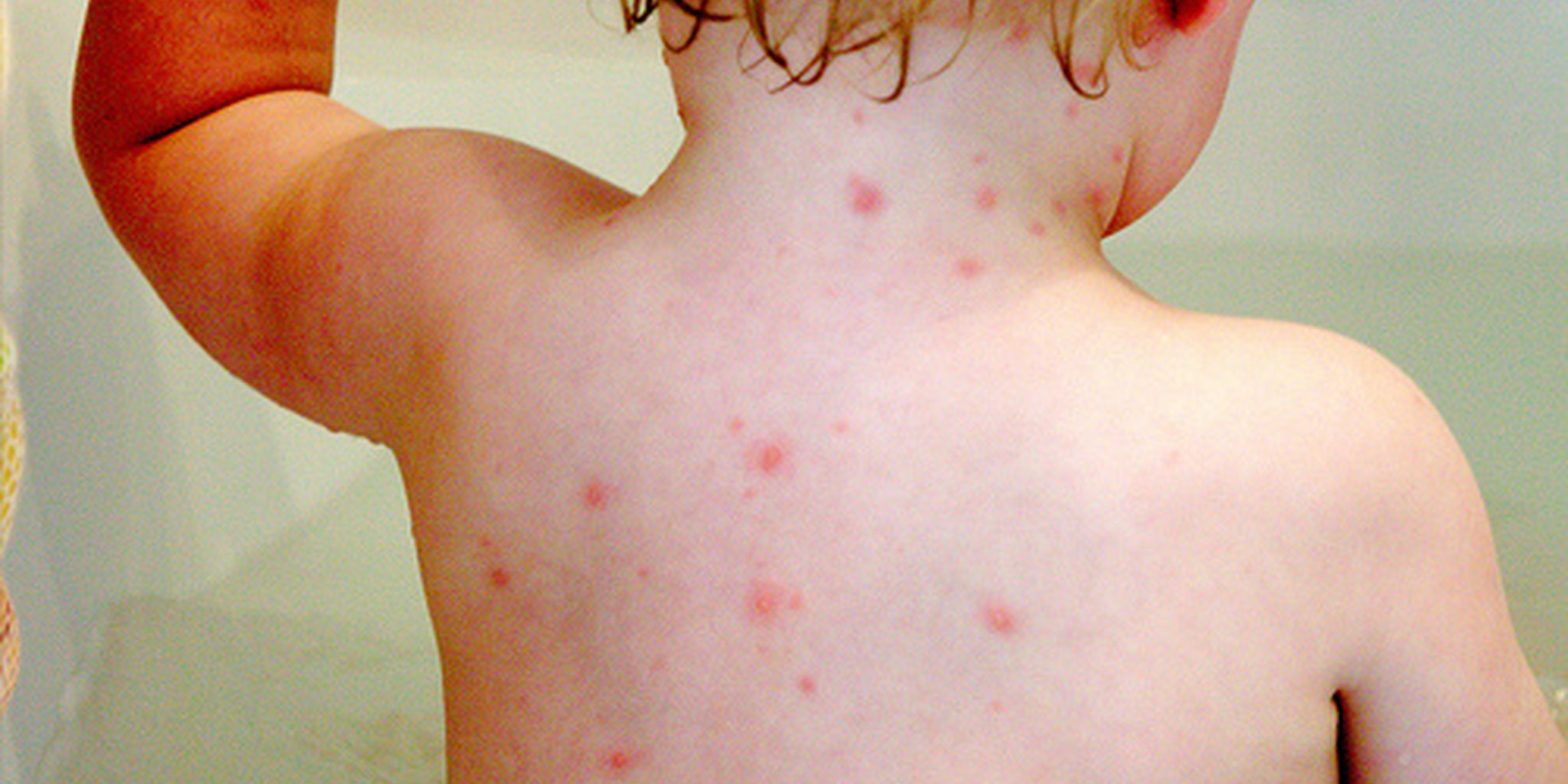 Chicken Pox Starting Symptoms In Hindi